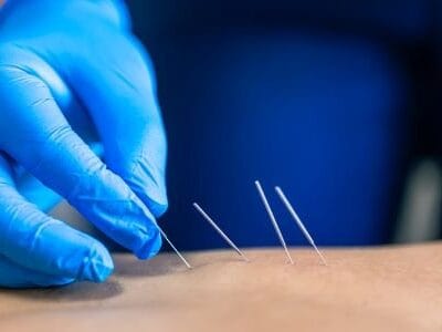 dry-needling