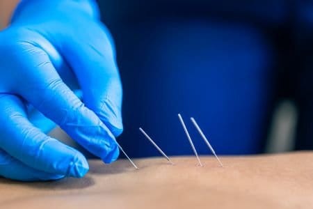 dry-needling