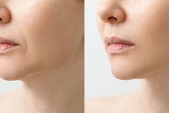Jawline Filler in Abu Dhabi1