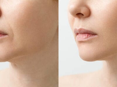 Jawline Filler in Abu Dhabi1