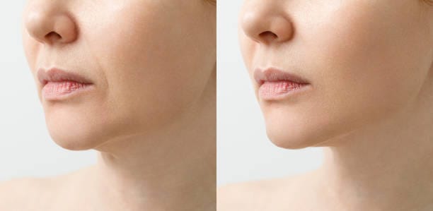 Jawline Filler in Abu Dhabi1