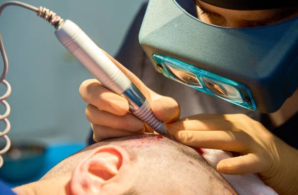 Hair Transplant in Riyadh