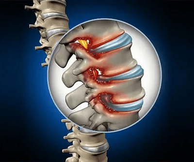 spinal-stenosis