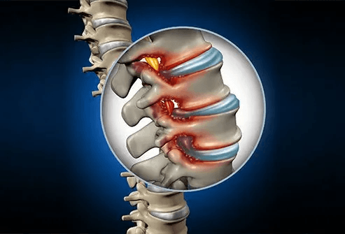 spinal-stenosis
