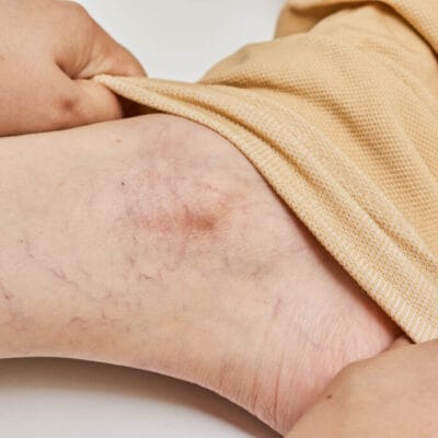 ما-الذي-يجعل-علاج-التصلب-فعالًا-جدًا؟