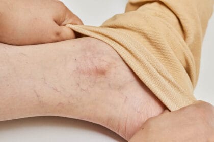 ما-الذي-يجعل-علاج-التصلب-فعالًا-جدًا؟