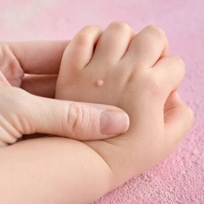 هل-علاج-إزالة-الثآليل-آمن-للأطفال؟