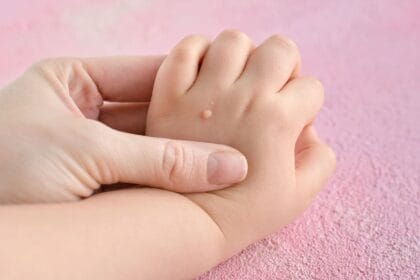 هل-علاج-إزالة-الثآليل-آمن-للأطفال؟