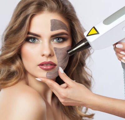 Can-Laser-Carbon-Peel-Clear-Acne-Quickly