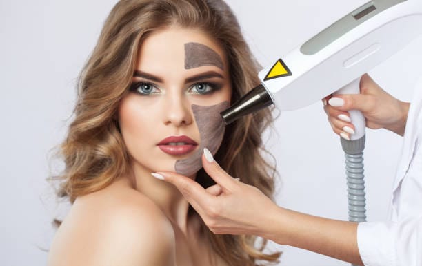 Can-Laser-Carbon-Peel-Clear-Acne-Quickly