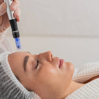 Can-RF-Microneedling-Reduce-Pigmentation-Problems
