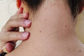 Can-Wart-Removal-Restore-Smooth-and-Clear-Skin