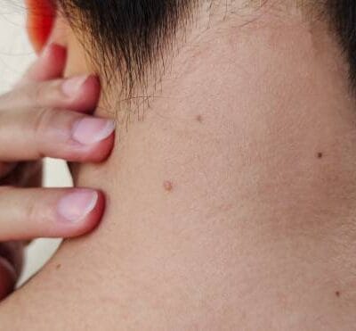 Can-Wart-Removal-Restore-Smooth-and-Clear-Skin