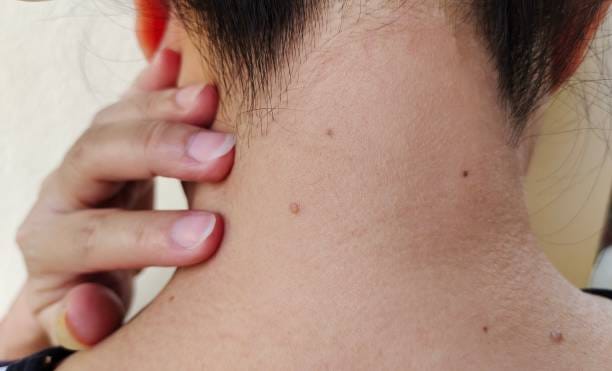 Can-Wart-Removal-Restore-Smooth-and-Clear-Skin