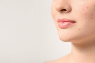 How-Can-Acne-Treatment-Improve-Skin-Tone-And-Texture-Naturally