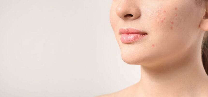 How-Can-Acne-Treatment-Improve-Skin-Tone-And-Texture-Naturally