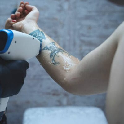 How-Does-Tattoo-Removal-Improve-Skin-Appearance
