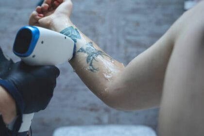 How-Does-Tattoo-Removal-Improve-Skin-Appearance