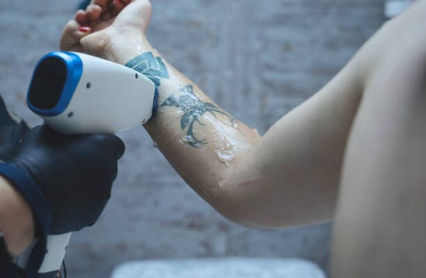 How-Does-Tattoo-Removal-Improve-Skin-Appearance
