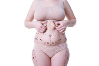 How-Many-Sessions-Needed-for-Liposuction