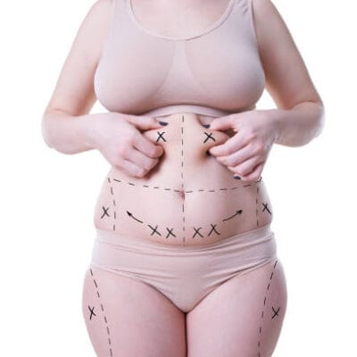 How-Many-Sessions-Needed-for-Liposuction