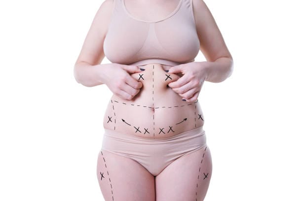 How-Many-Sessions-Needed-for-Liposuction