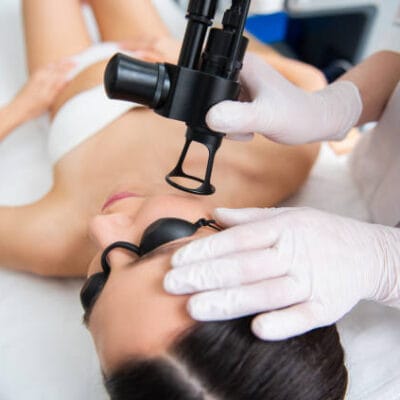 How-Quickly-Does-Pico-Laser-Fade-Acne-Scar-Appearance