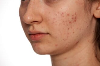 How-Safe-Is-Laser-Acne-Scar-treatment-For-Dark-Skin-Tones