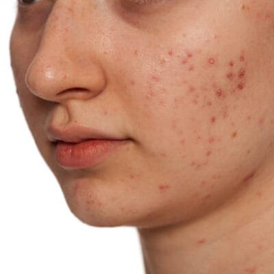 How-Safe-Is-Laser-Acne-Scar-treatment-For-Dark-Skin-Tones