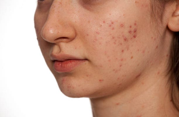 How-Safe-Is-Laser-Acne-Scar-treatment-For-Dark-Skin-Tones
