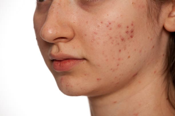 How-Safe-Is-Laser-Acne-Scar-treatment-For-Dark-Skin-Tones