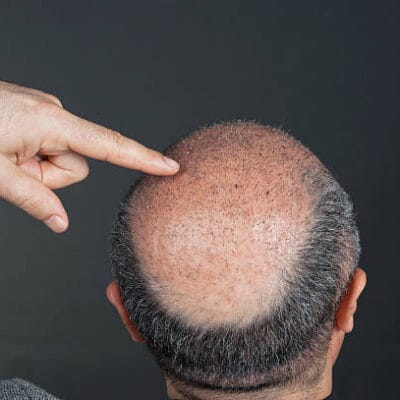 How-Soon-Can-Hair-Transplant-Results-Start-Looking-Fuller