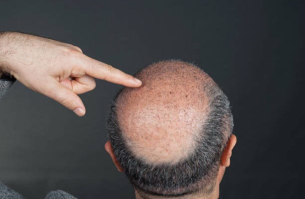 How-Soon-Can-Hair-Transplant-Results-Start-Looking-Fuller