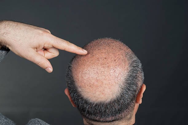 How-Soon-Can-Hair-Transplant-Results-Start-Looking-Fuller