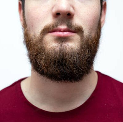 Is-Beard-Hair-Transplant-a-Good-Solution-for-Small-Beards