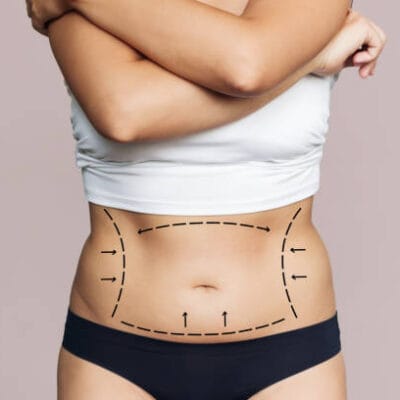 Is-Body-Jet-Liposuction-Good-For-Belly-Fat-Removal-Right