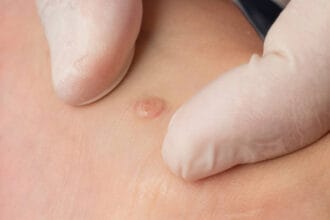 Is-Wart-Removal-Suitable-for-Children-and-Teenagers