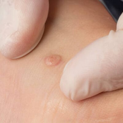 Is-Wart-Removal-Suitable-for-Children-and-Teenagers