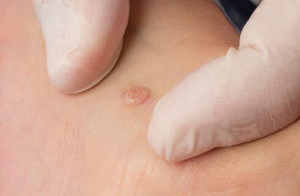 Is-Wart-Removal-Suitable-for-Children-and-Teenagers