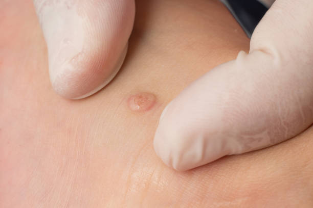 Is-Wart-Removal-Suitable-for-Children-and-Teenagers