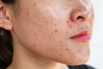 What-Acne-Treatment-Works-Best-for-Adults