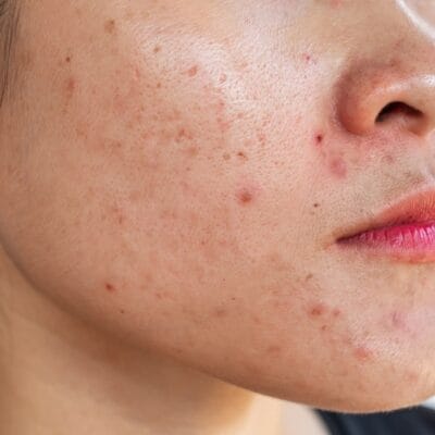 What-Acne-Treatment-Works-Best-for-Adults
