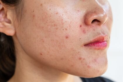 What-Acne-Treatment-Works-Best-for-Adults