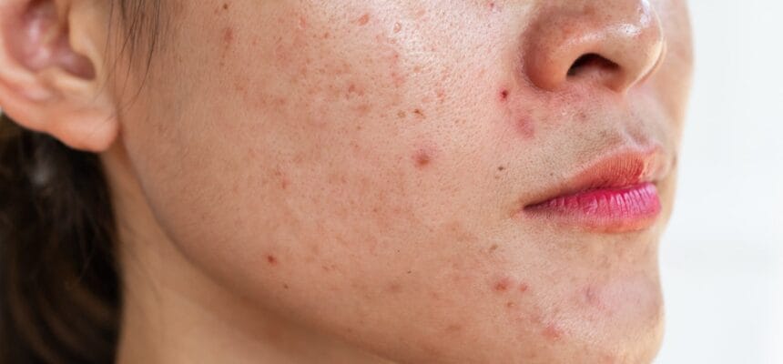 What-Acne-Treatment-Works-Best-for-Adults