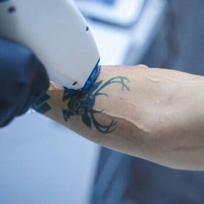 What-Are-the-Benefits-of-Modern-Laser-Tattoo-Removal
