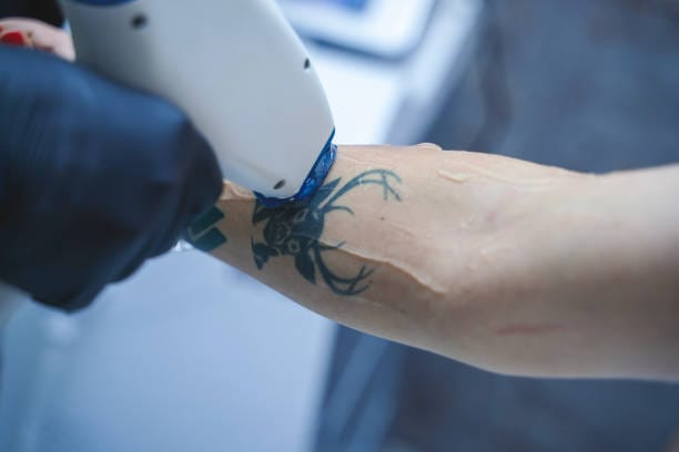 What-Are-the-Benefits-of-Modern-Laser-Tattoo-Removal