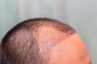 What-Hair-Transplant-Method-Works-Best-Today