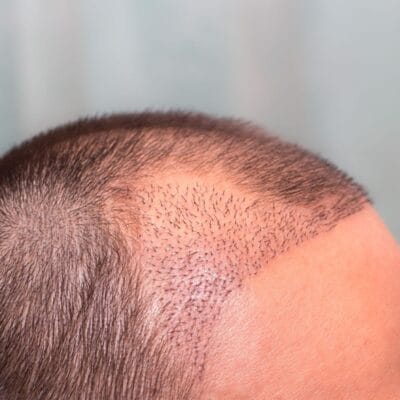 What-Hair-Transplant-Method-Works-Best-Today