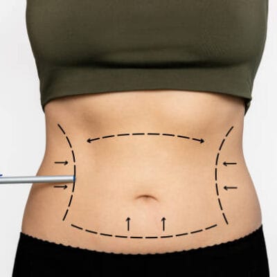 What-Makes-Liposuction-A-Top-Choice-For-Targeted-Fat-Loss