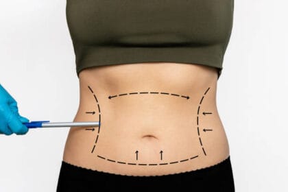 What-Makes-Liposuction-A-Top-Choice-For-Targeted-Fat-Loss